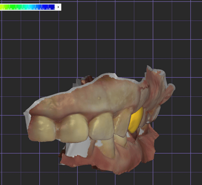 CAD/CAM冠の製作