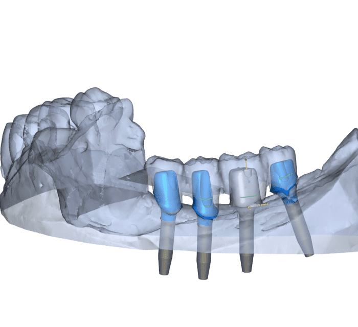 CAD/CAM冠の製作